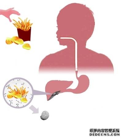 胆结石怎么吃？医生告诉你：7类食物禁忌，四级预防让你远离结石