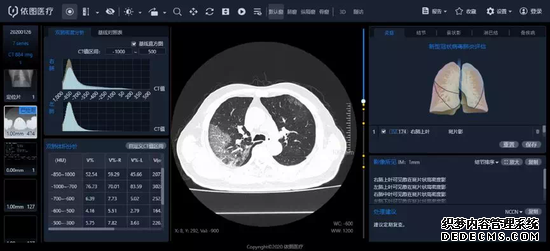 AI系统可智能诊断新冠肺炎CT影像 在上海多家医院投用