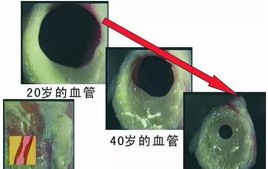 揭露“三高”真相：高血压、高血脂、高血糖