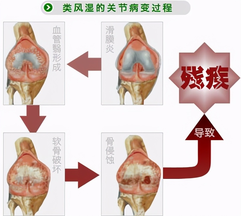 这些病症你中了几项？超过4项患类风湿性关节炎的几率极高