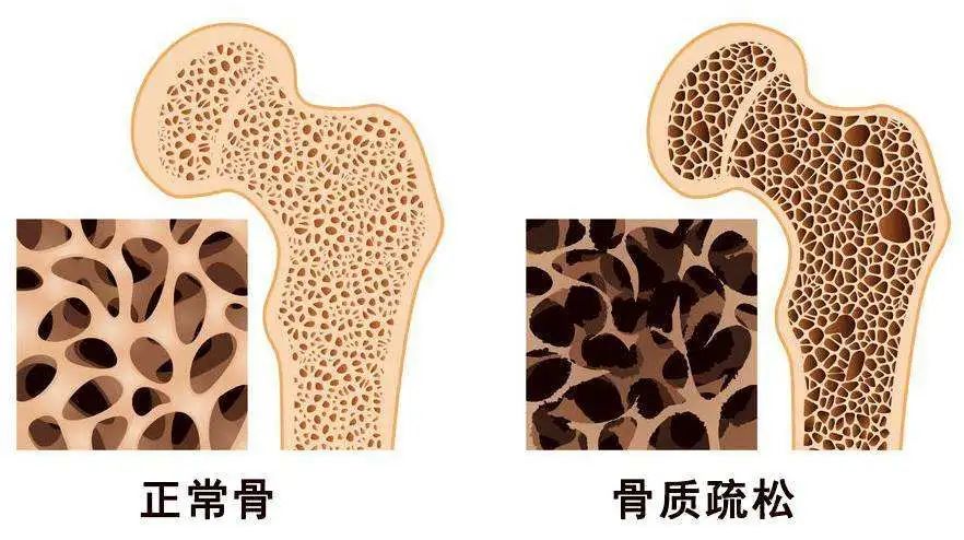 世界骨质疏松日 | 预防“骨质疏松”补钙就可以了吗？营养专家送你一份“护骨秘籍”