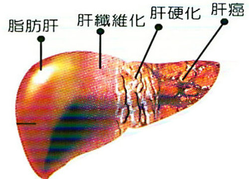 脂肪肝前期表现以及脂肪肝的预防方法